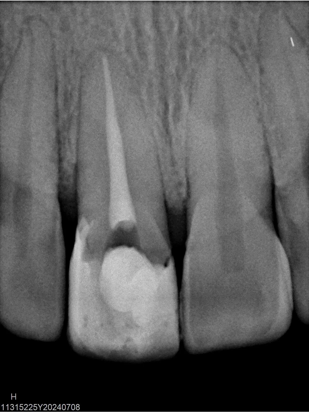 Radiografía periapical